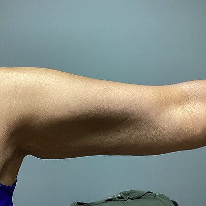 Female arms after Lipo procedure