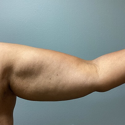 Female arms before Lipo procedure