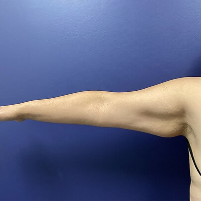 Side Angle of Female Arms Before Liposuction Procedure