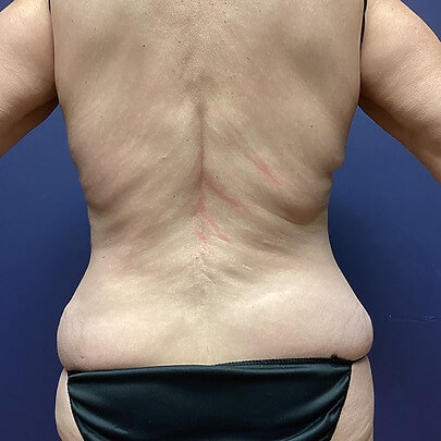 Back Angle of Female after BBR Stomach Waist AbEX procedure
