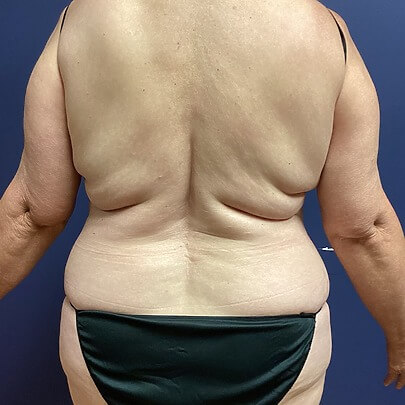 Back Angle of Female before BBR Stomach Waist AbEX procedure