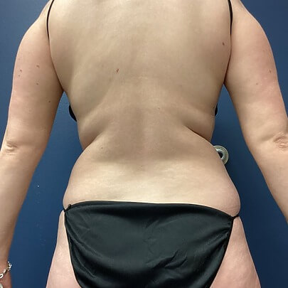 Back angle of female before procedure