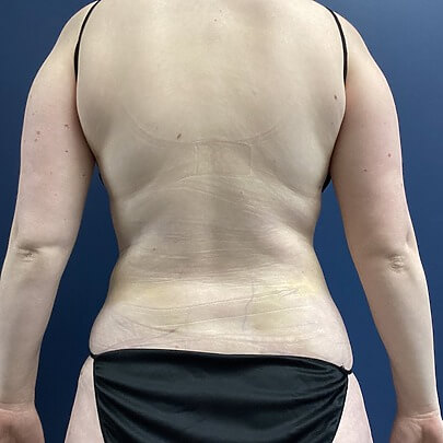 Back angle of female after procedure