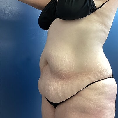 Side angle of female before AbEX stomach and waist procedure