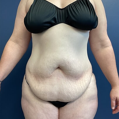 Front angle of female before AbEX stomach and waist procedure