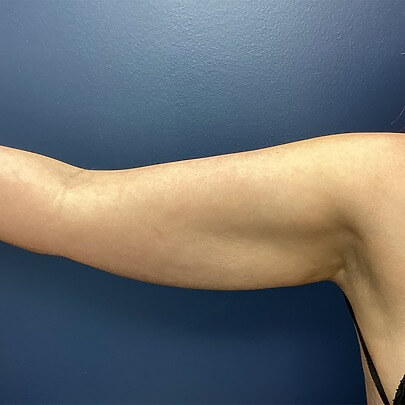 Side angle of female arms before lipo procedure