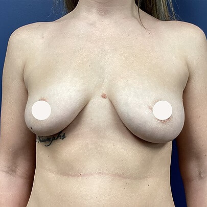 Front Angle of Female Breast Before Breast Augmentation Procedure