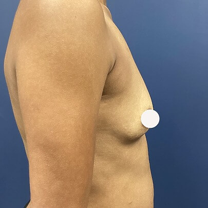 Side Angle of Female Breast Before Breast Augmentation Procedure
