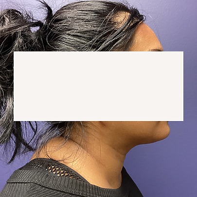 Female chin side profile after chin liposuction at Sono Bello