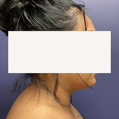 Female patient side profile before chin liposuction at Sono Bello