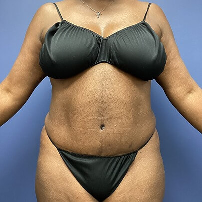 Front angle of female after AbEX stomach and waist procedure