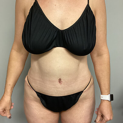 Front Angle Female Stomach After AbEX