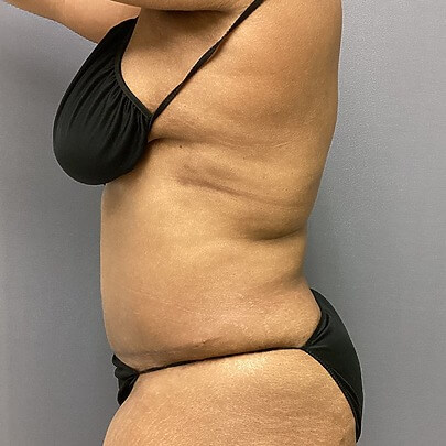 Side angle of female after AbEX stomach and waist procedure