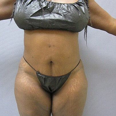Front angle of female after stomach and waist procedure