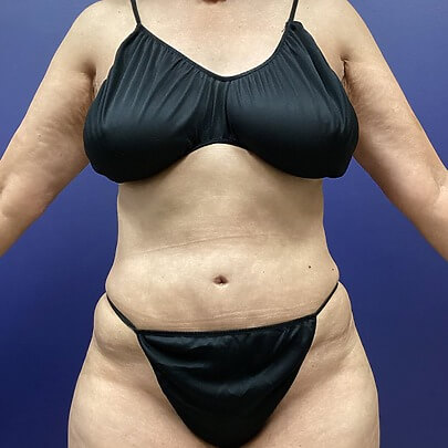 Front angle of female after AbEX stomach and waist procedure