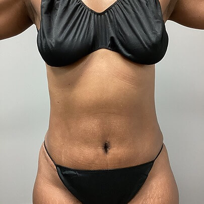 Front angle of female after AbEX stomach procedure