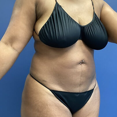 Side Angle of Female Stomach, Waist, Back, BBR After Lipo