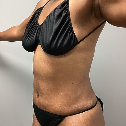 Side front angle of female after AbEX stomach procedure