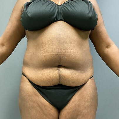 Front angle of female before AbEX stomach and waist procedure