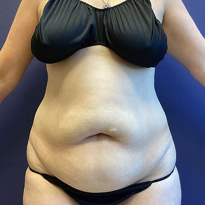 Front Angle Female Stomach Before AbEX