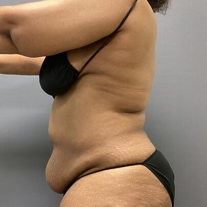 Side angle of female before AbEX stomach and waist procedure