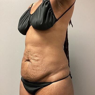 Side angle of female before AbEX stomach procedure