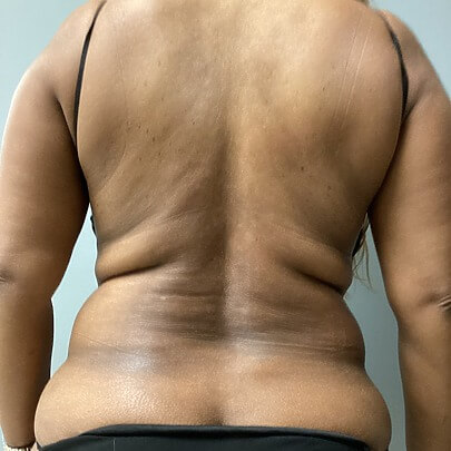Back Angle of Female Stomach Before Liposuction