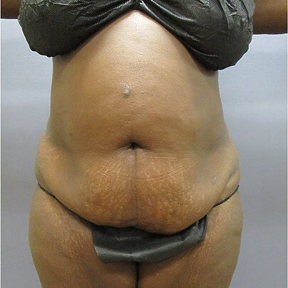 Front angle of female before stomach and waist procedure
