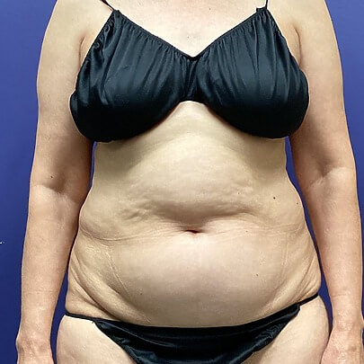 Front angle of female before AbEX stomach and waist procedure