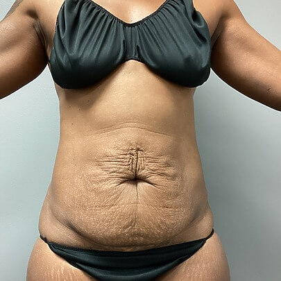 Front angle of female before AbEX stomach procedure