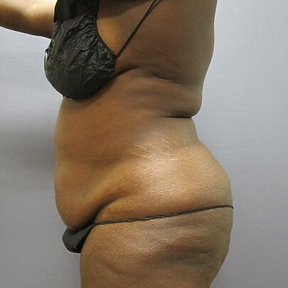 Side angle of female before stomach and waist procedure