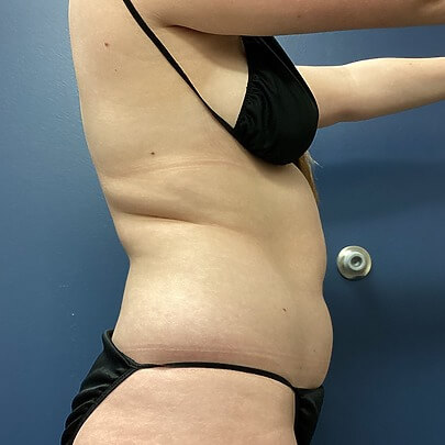 Side angle of female before Lipo stomach procedure