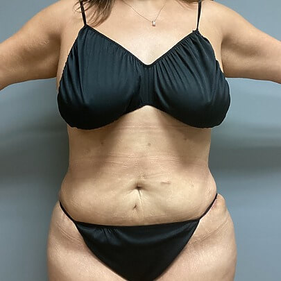 Front angle of female after AbEX stomach and waist procedure