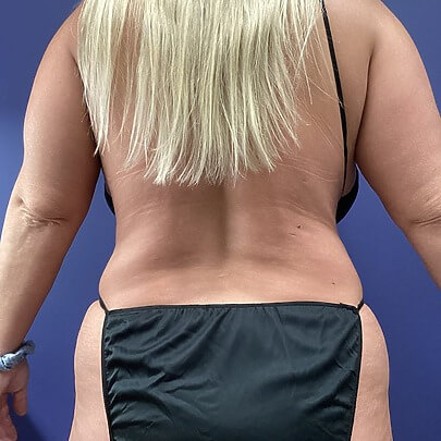 Back angle of female after Lipo stomach and waist procedure