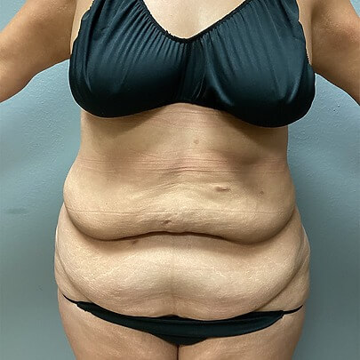 Front angle of female before AbEX stomach and waist procedure
