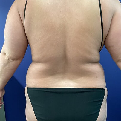 Back angle of female before Lipo stomach and waist procedure