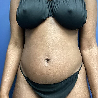 Side angle of female before Lipo stomach, waist, procedure