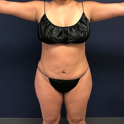 Front angle of female after AbEX, Lipo stomach and waist procedure