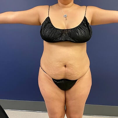 Front angle of female before AbEX, Lipo stomach and waist procedure