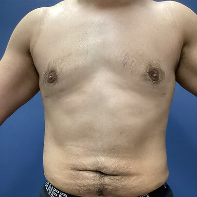 Male Chest After ChestEX Procedure Front