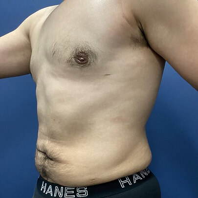 Male Chest After ChestEX Procedure Side Angle