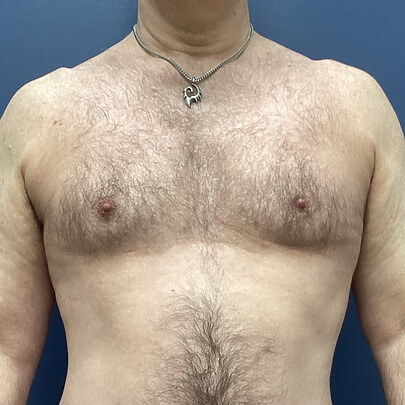 View of Male Chest After Liposuction Front