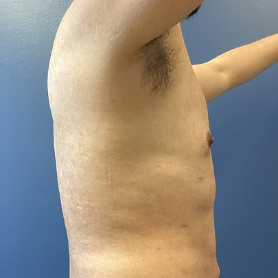 View of Male Chest After Liposuction Side Angle