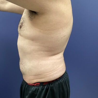 Male Front Angle Chest After Liposuction Side