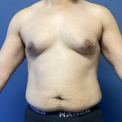 Male Chest Before ChestEX Procedure Front