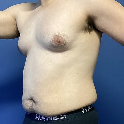 Male Chest Before ChestEX Procedure Side Angle