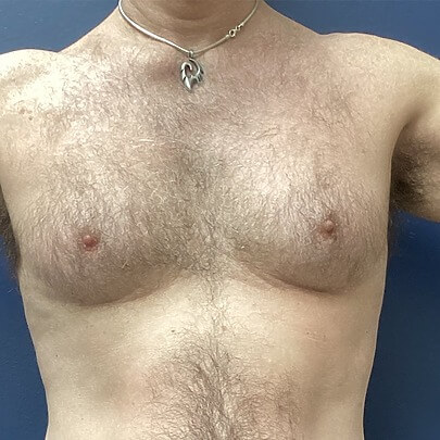 View of Male Chest Before Liposuction Front