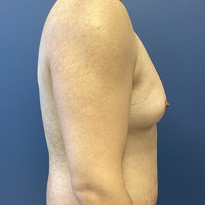 View of Male Chest Before Liposuction Side Angle