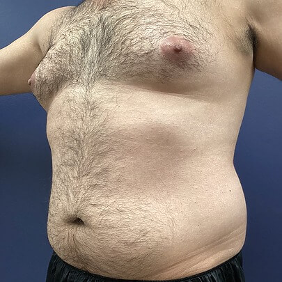 Male Chest Before Procedure Side