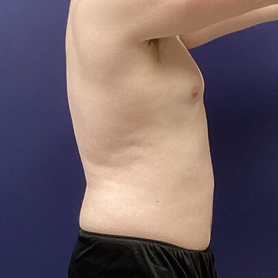 Side angle of male after stomach, back and waist procedure